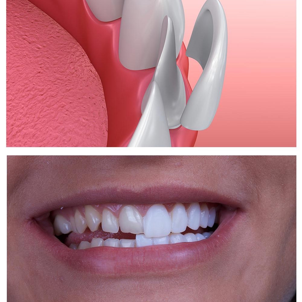dental-veneer-เคลือบฟันเทียม
