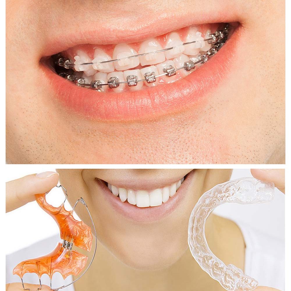 orthodontic-จัดฟัน