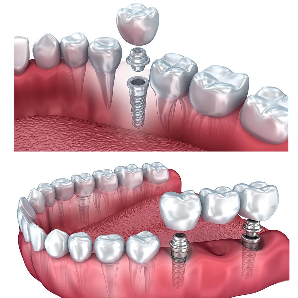 dental-implant-รากฟันเทียม