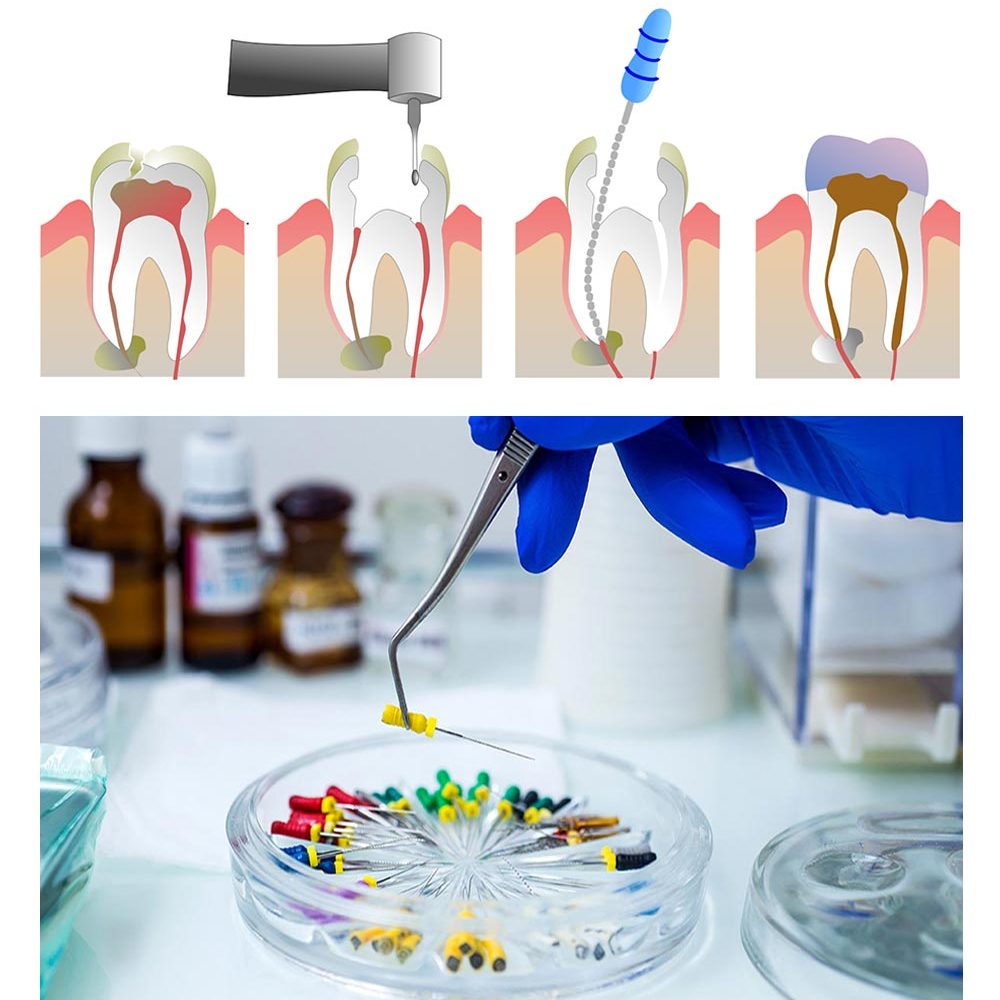 endodontic-รักษารากฟัน
