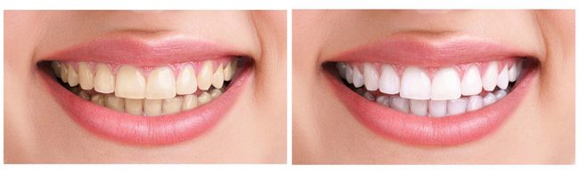 teeth-whitening-ฟอกสีฟัน-2