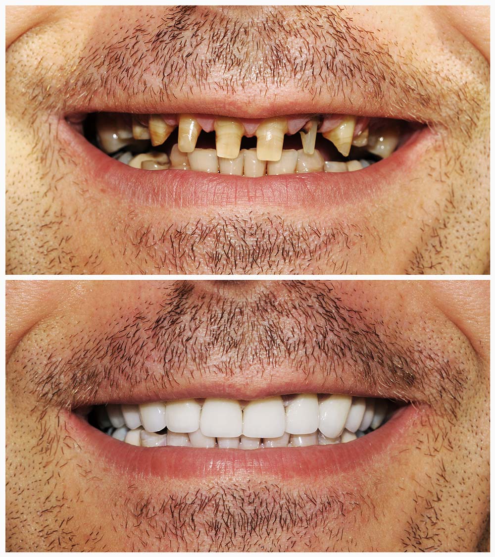 dental-crowns-pattaya-smile-dental-clinic