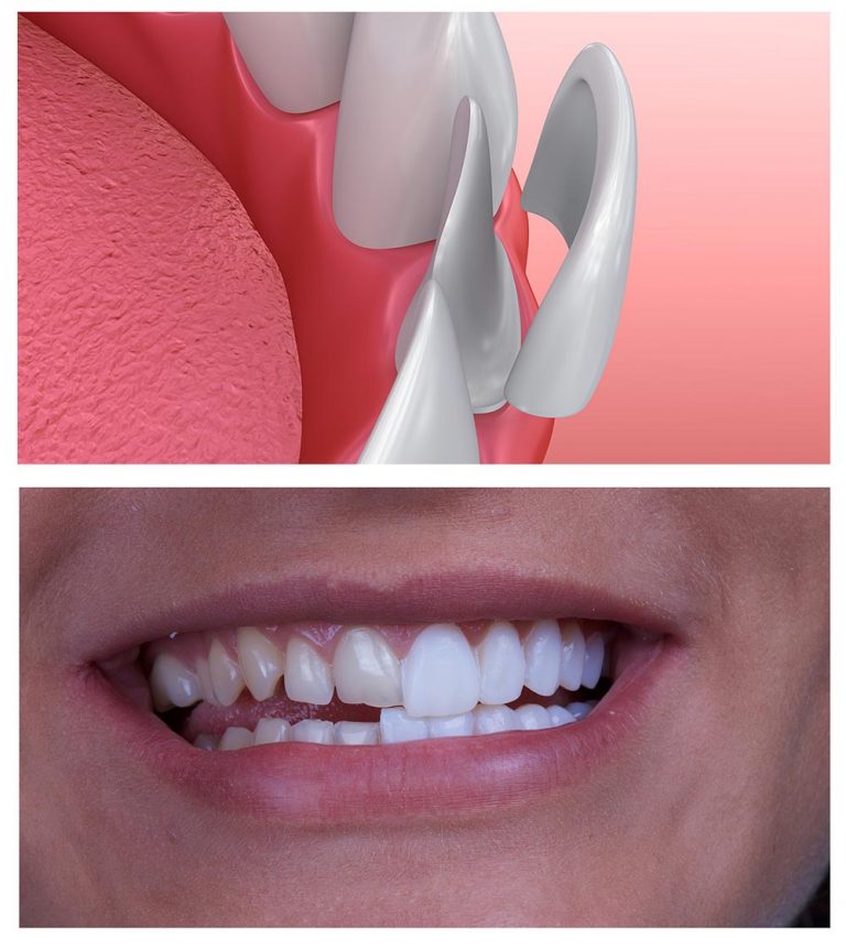Porcelain Veneer