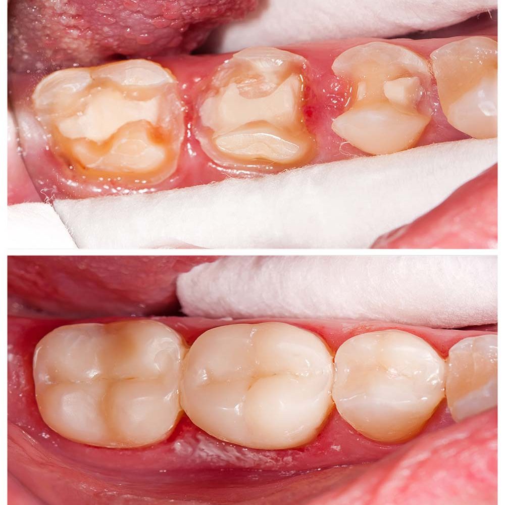 porcelain-inlay-onlay-อุดฟันด้วยเซรามิก