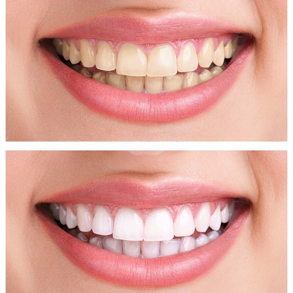 teeth-whitening-ฟอกสีฟัน