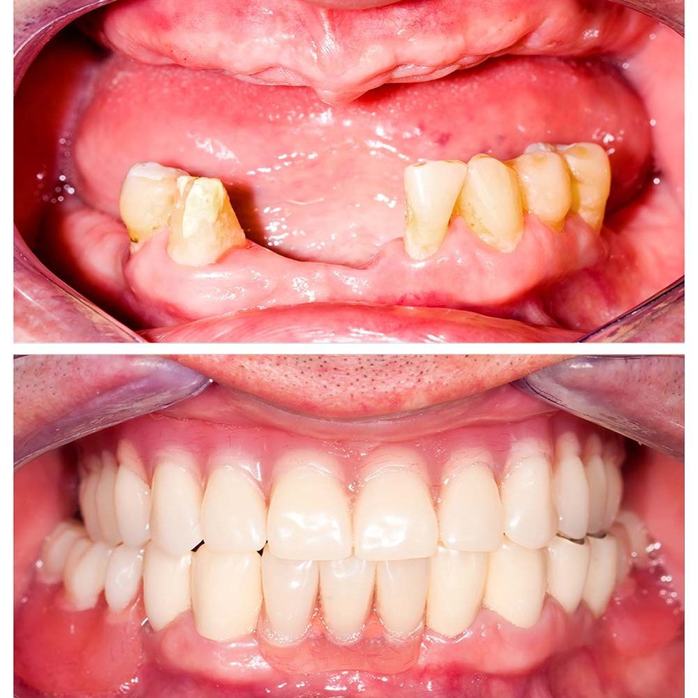 denture-ฟันปลอมถอดได้