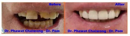 Before and after: front teeth restored with crowns