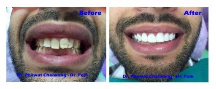 Before and after: full smile makeover