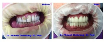 Before and after: veneers