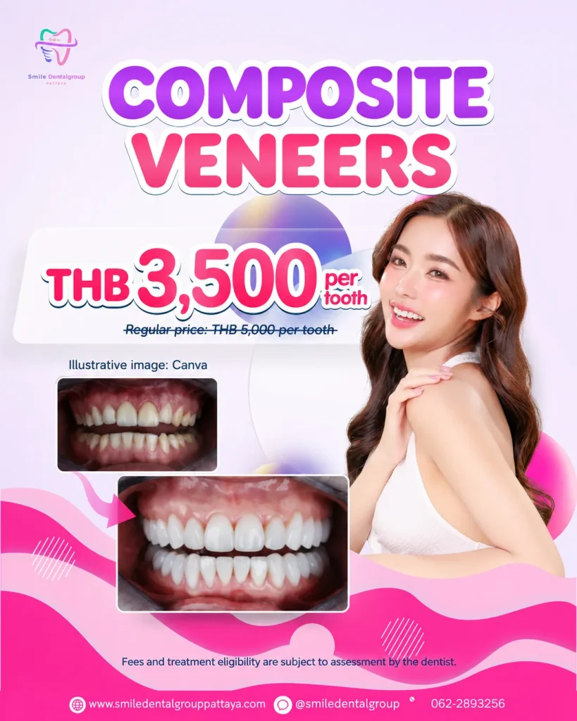 Composite veneers THB 3,500 per tooth, regular price THB 5,000