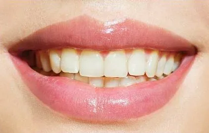 Teeth before whitening